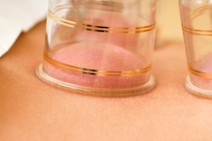 Cupping Chinese Cupping